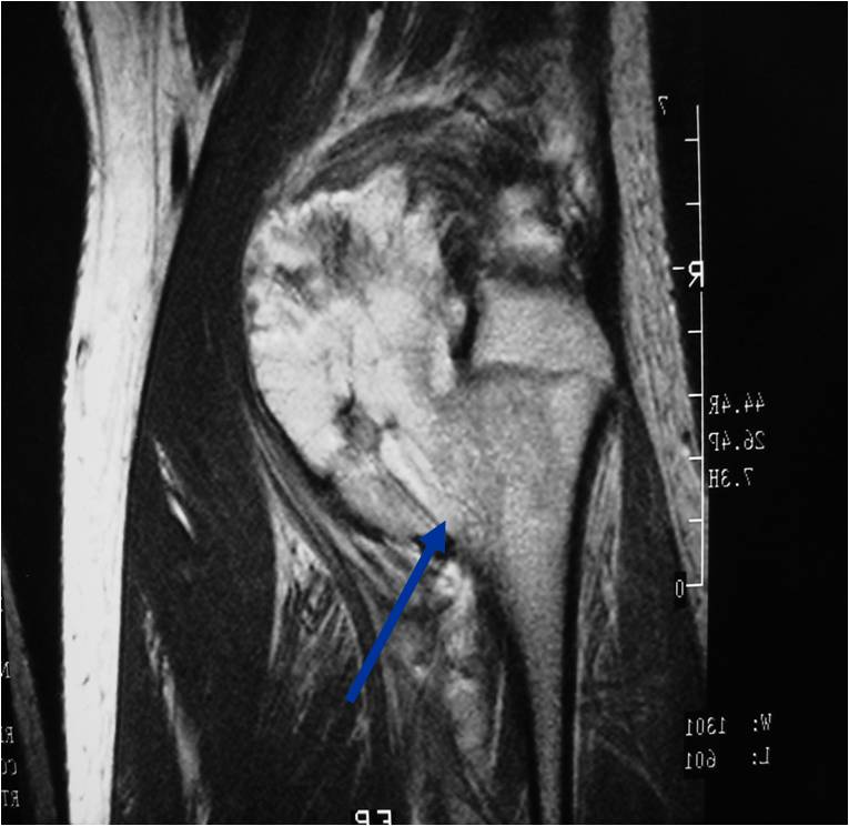 MRI Demonstrates Stalk and Continuity with Underlying Fibula; Thin Cartilaginous Cap