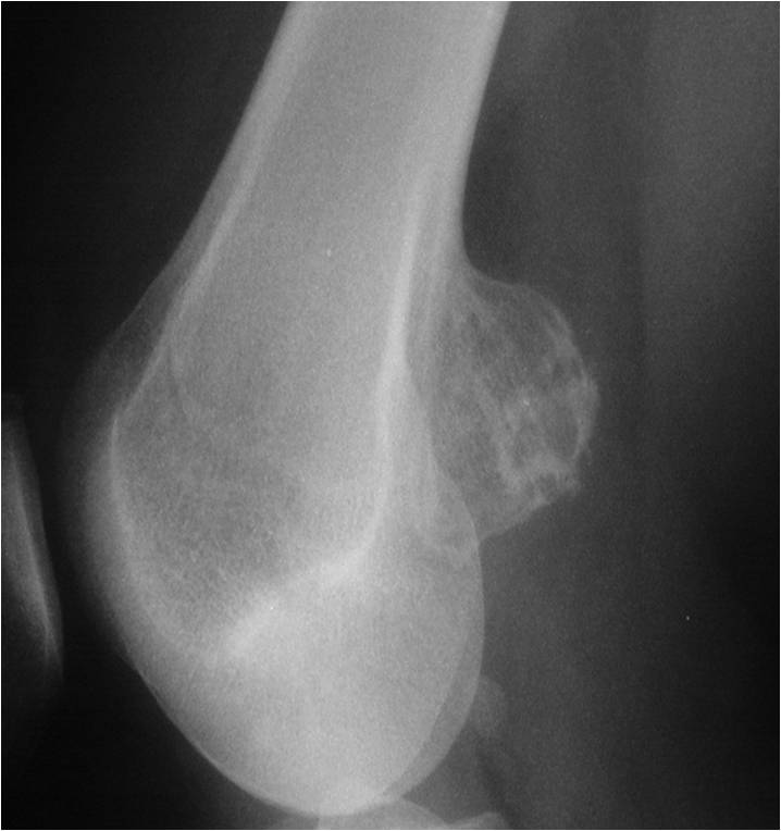 Plain Xray/MRI: Distal Femur Sessile Osteochondroma