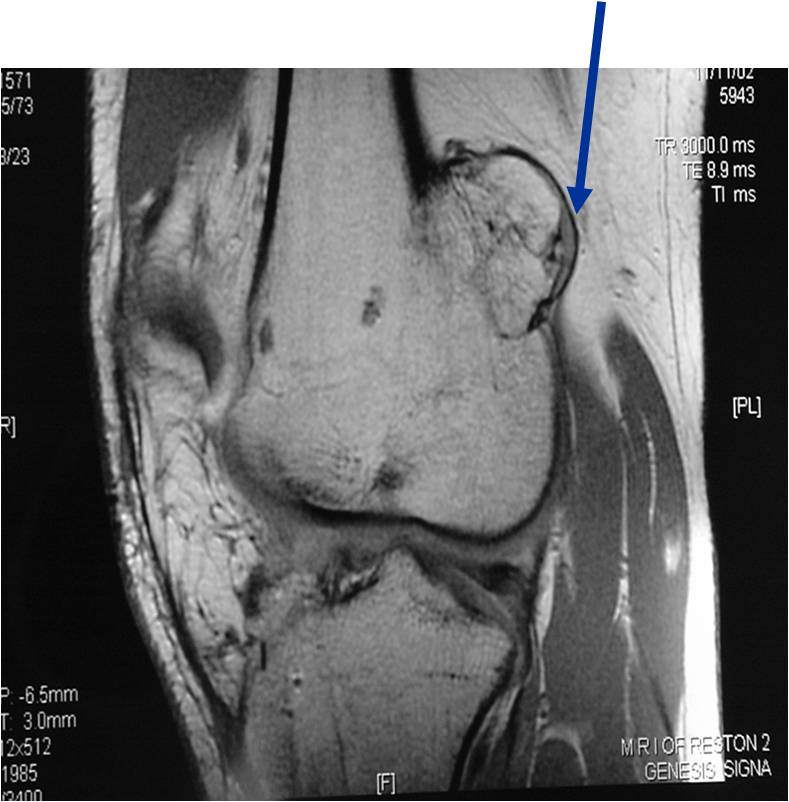 Plain Xray/MRI: Distal Femur Sessile Osteochondroma - (arrow) The Cartilage Cap
