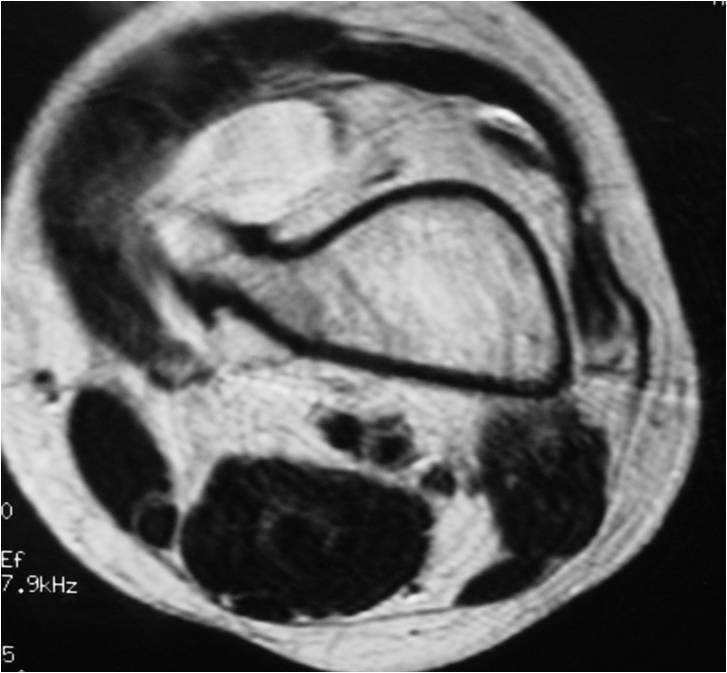 Xay/MRI: Distal Femur Osteochondroma