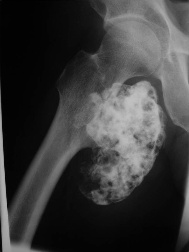 Osteochondroma of Proximal Femur (Even though this was a large tumor, the cartilage cap was very thin)