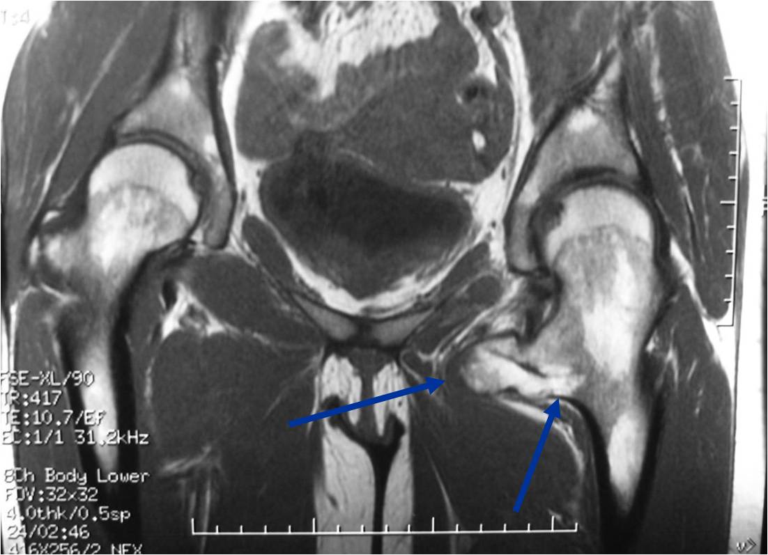 MRI: Left proximal Femur Osteochondroma Cortical Medullary Continuity and Thin Cartilage Cap