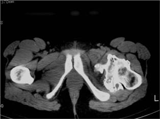 CT Scan: Left Proximal Femur Osteochondroma