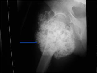 Plain X-ray: Secondary Chondrosarcoma of Proximal Femur