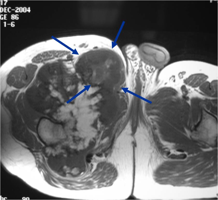 MRI: Secondary Chondrosarcoma of Proximal Femur: Thick Cartilage Cap (>2cm)