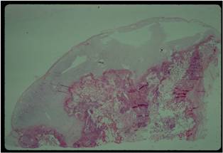 Microscopic Pathology:  Osteochondroma