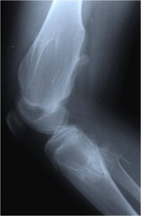 X-ray: Multiple Hereditary Osteochondromas of Distal Femur and Proximal Tibia/Fibula