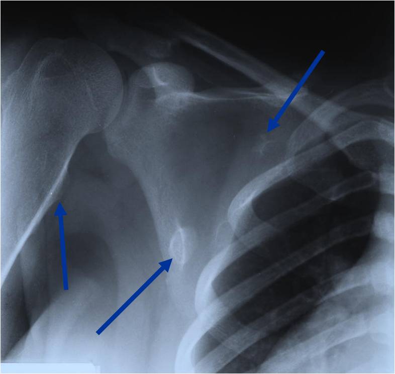 X-Ray: Multiple Hereditary Osteochondromas of Scapula/Proximal Humerus