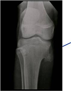 Plain X-Ray:  Osteochondroma of Proximal Tibia