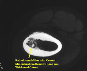CT Scan: Osteoid Osteoma of Femur