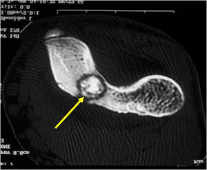 Osteoid Osteoma of Distal Humerus:  CT Shows Nidus with Extensive Mineralization