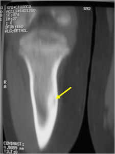 CT Scan: Osteoid Osteoma of Tibia