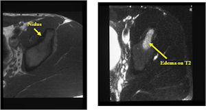 MRI of Osteoid Osteoma of Acetabulum  (Nidus not Clearly Visualized) There is Extensive Surrounding Edema