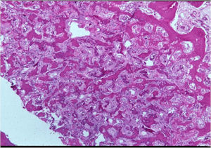 Microscopic Pathology: Osteoid Osteoma