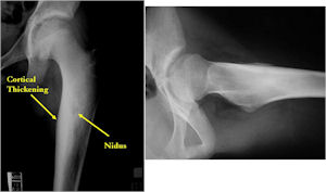 Plain X-ray: Osteoid Osteoma