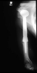 Plain Xray: Proximal Humerus Tumor Prosthesis after Extra-articular Resection of, Proximal Humerus Osteosarcoma