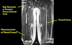MRI: Osteosarcoma of distal femur with skip metastasis to proximal femur 