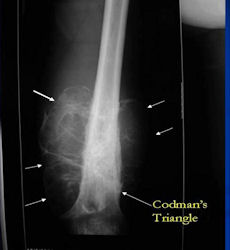X-Ray:  Osteosarcoma Of Distal Femur