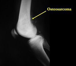 X-RAY:  AP and lateral x-ray, osteosarcoma of distal femur