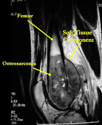 MRI of osteosarcoma of distal femur (same patient) 
