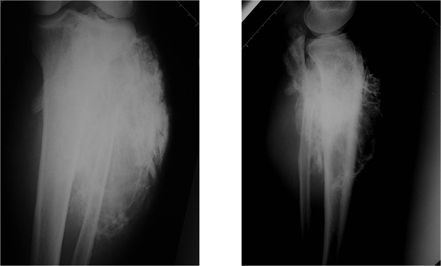 X-RAY:  Large Osteosarcoma of Proximal Tibia