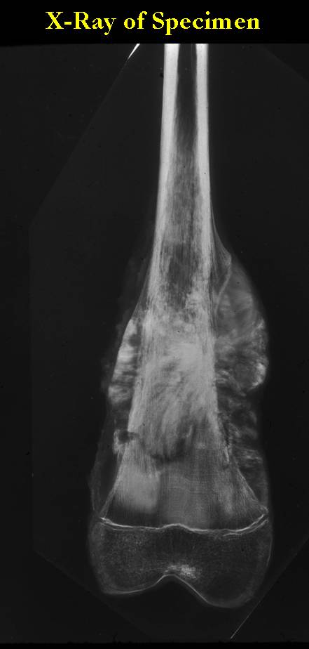Gross Pathology:  Osteosarcoma of Distal Femur