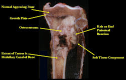 Gross Pathology:  Conventional Osteosarcoma of Proximal Tibia