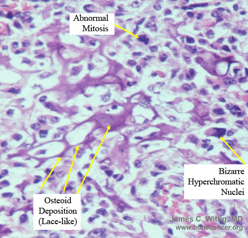 Microscopic Pathology:  Conventional Osteosarcoma