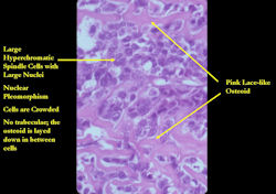 Microscopic Pathology:  High Power of Conventional Osteosarcoma