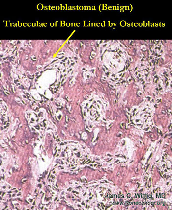 Microscopic Pathology:  Osteoblastoma vs. Osteosarcoma