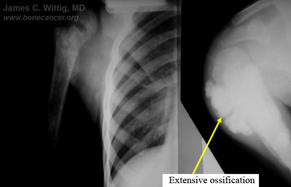 X-rays: Proximal humerus osteosarcoma