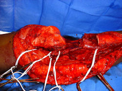 INTRAOPERATIVE IMAGES
