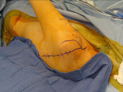 Radical Limb Sparing Extra-Articular Resection and Prosethetic Reconstruction