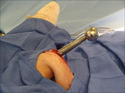 Placement of Cemented Proximal Humerus Tumor Prosthesis