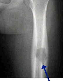 X-ray: Eosinophilic Granuloma of Femur
