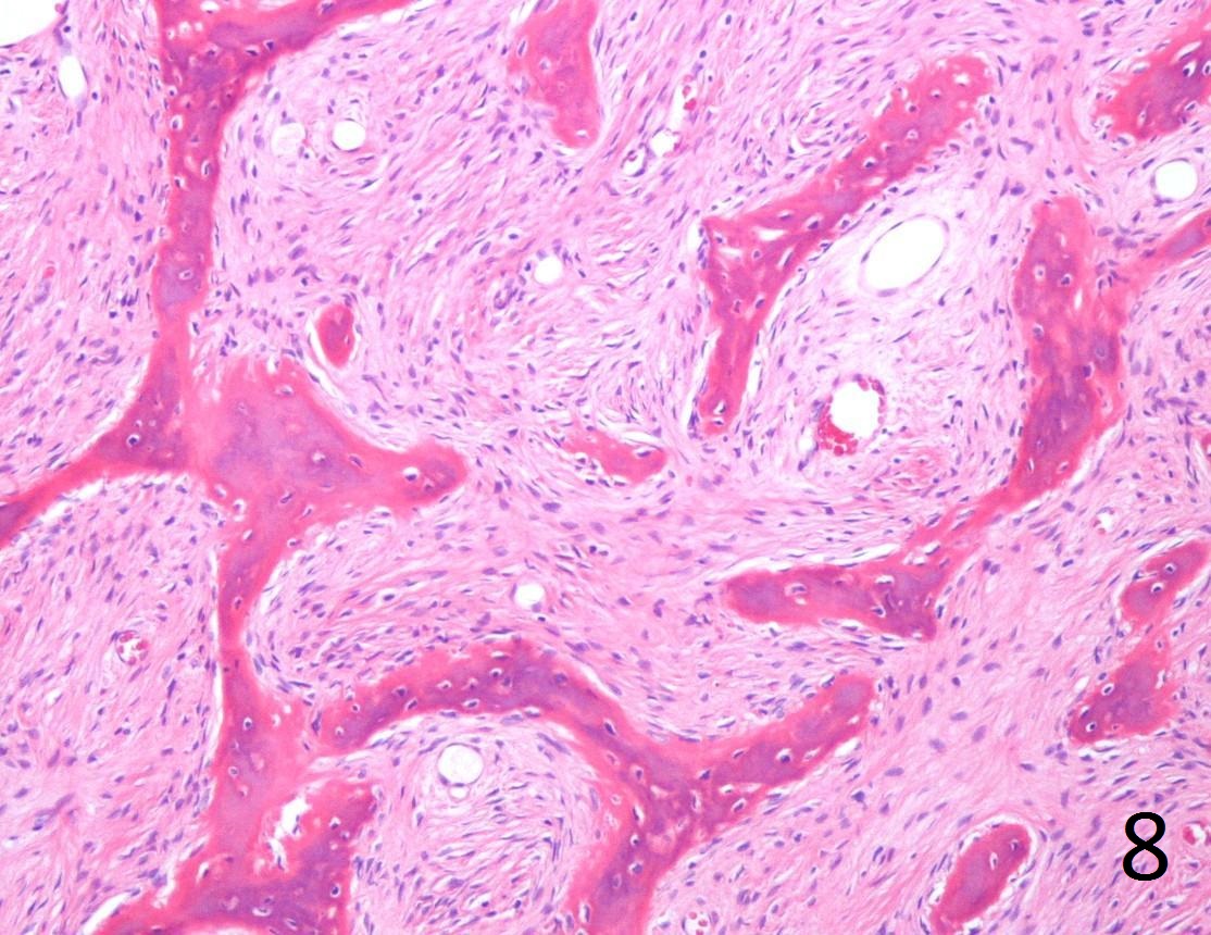 polyostotic fibrous dysplasia of bone