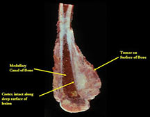 Gross specimen: parosteal osteosarcoma, distal femur