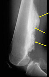 AP/lateral radiograph: Parosteal osteosarcoma of posterior distal femur