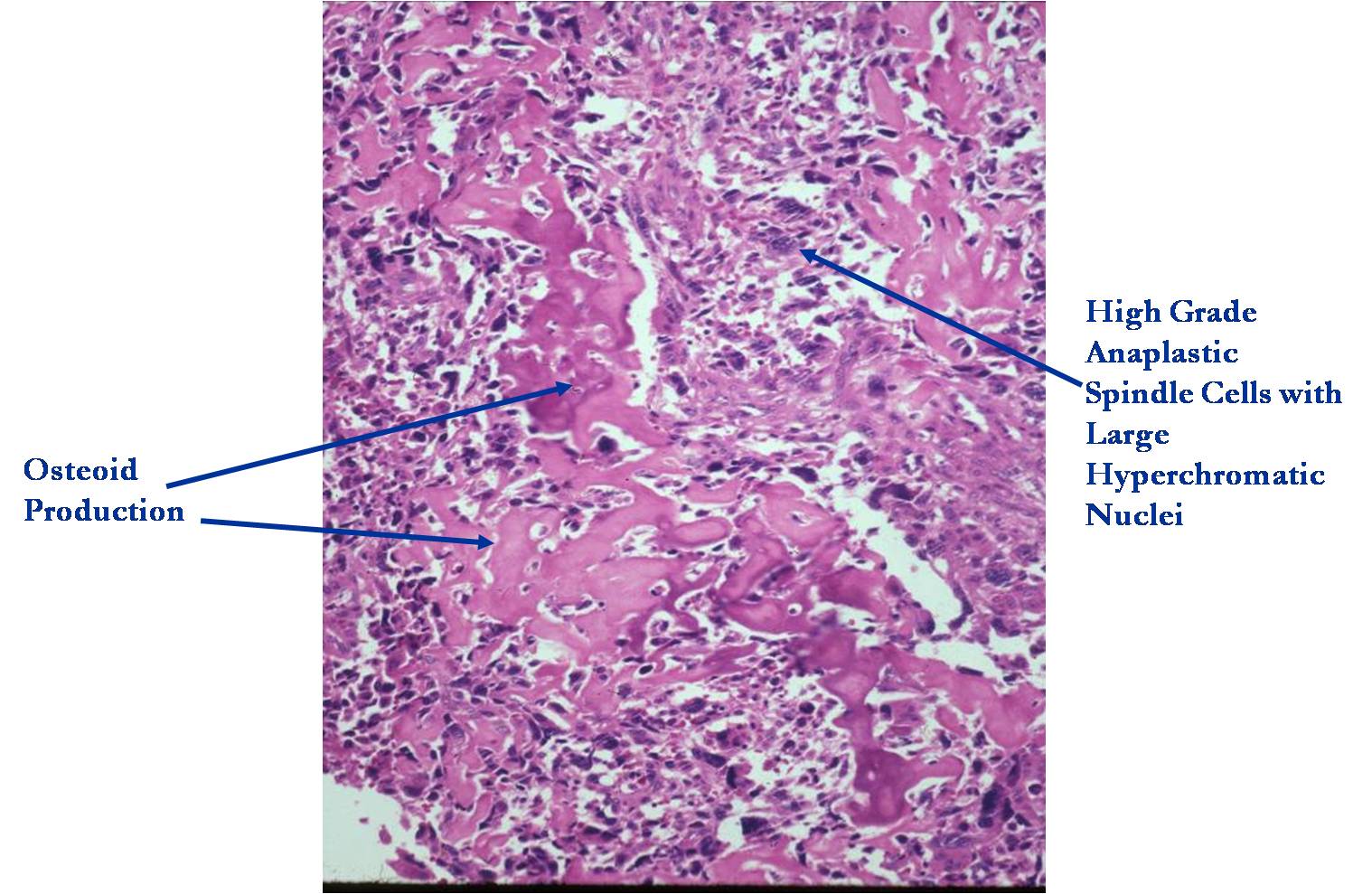 Osteosarcoma Histology Labeled
