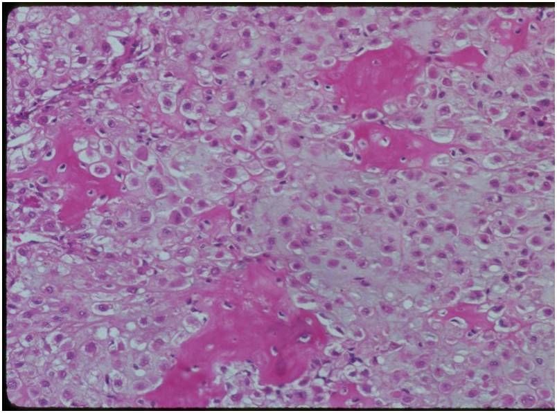 histology: clear cell chondrosarcoma