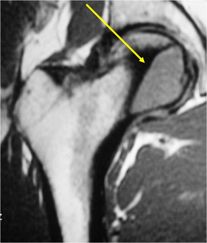 T1-weighted MRI proximal femur: clear cell chondrosarcoma