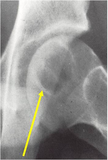 Left proximal femur: clear cell chondrosarcoma