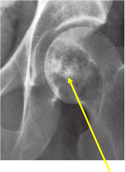 Plain X-ray of clear cell chondrosarcoma of proximal femur