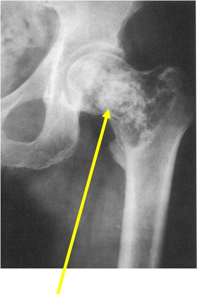 Plain X-ray:   Proximal femur clear cell chondrosarcoma