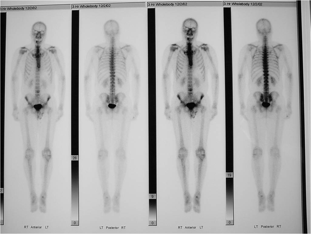 Bone Scan: Enchondroma of Middle Phalanx Uptake in Lesion is Less than Anterior Superior Iliac Spine (ASIS)