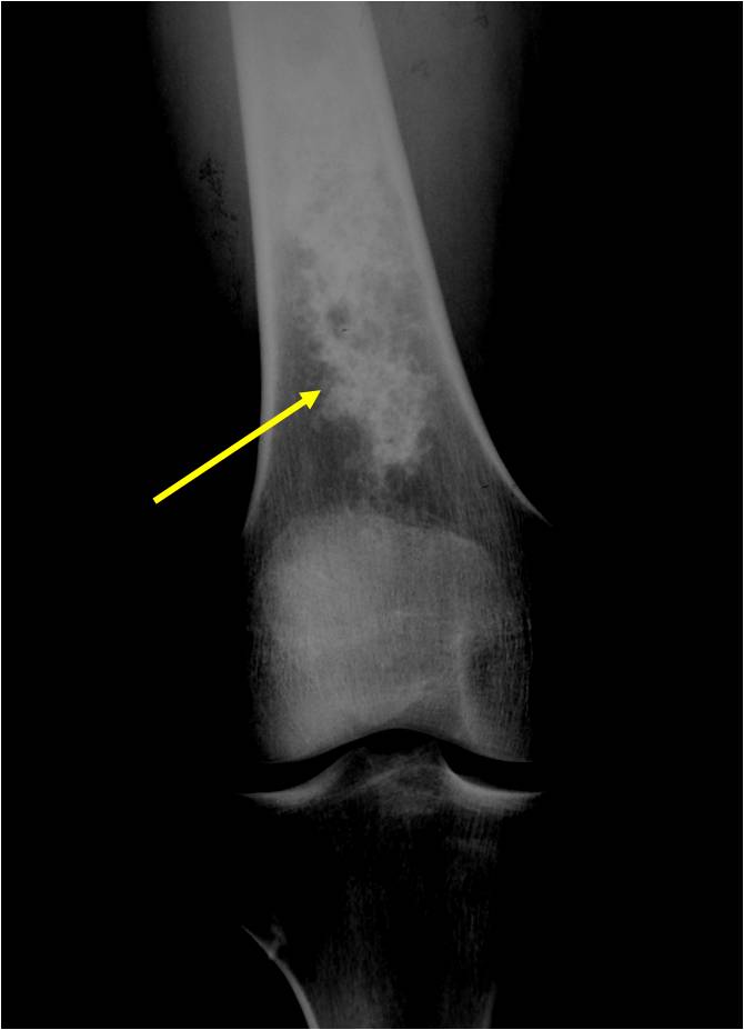 Plain X-Ray: Enchondroma of Femur