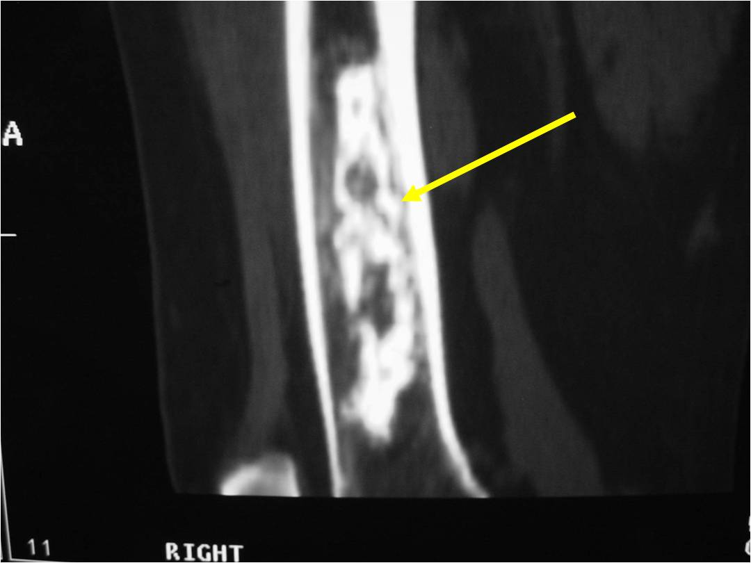 CT Scan: Enchondroma of Femur