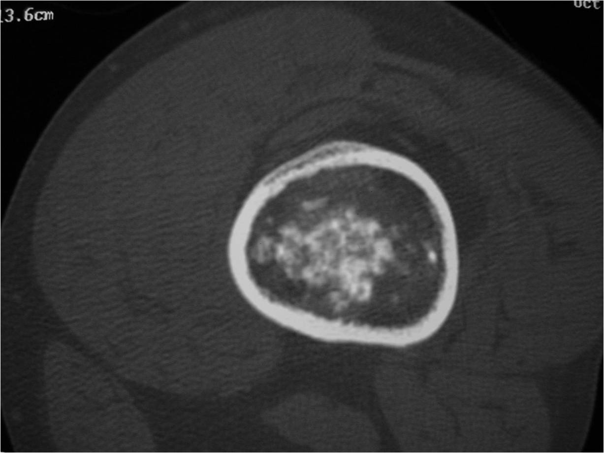 CT Scan: Enchondroma of Femur: Ring and Arc-Calcifications