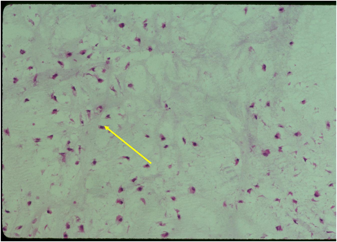 Microscopic Pathology:  Enchondroma