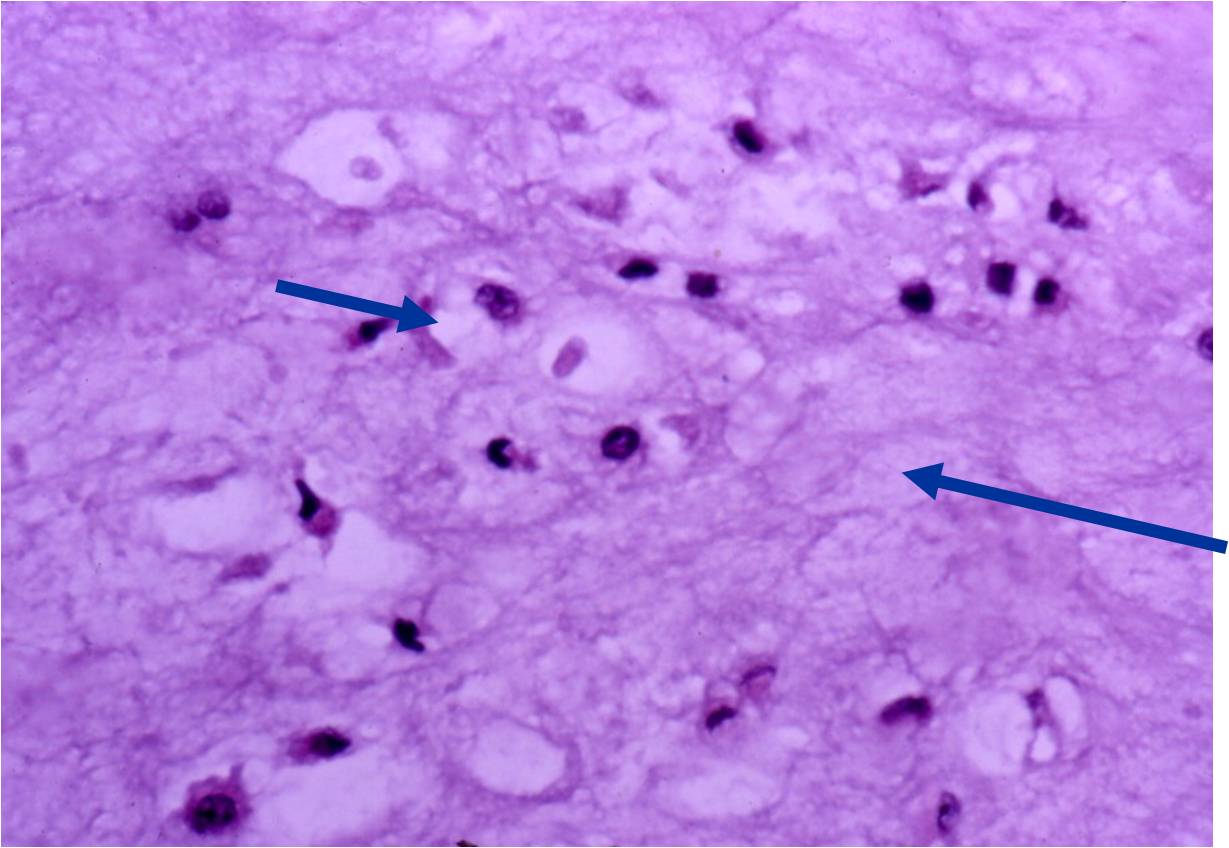 Microscopic Pathology: Enchondroma of a Digit